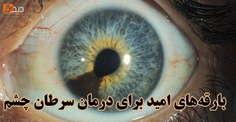 بارقه های امید برای درمان ملانومای چشم
