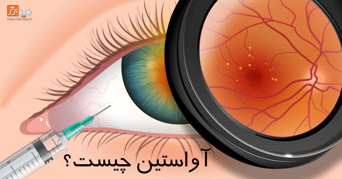 تزریق آواستین برای درمان درمان بیماری های چشمی مانند AMD و بیماری چشمی دیابتی